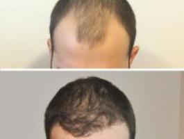 Greffe de cheveux Turquie